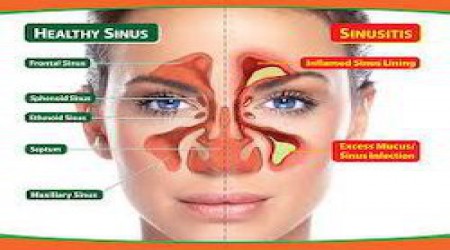 Nose & Sinus Surgery by Special Ear Nose Throught Hospital
